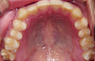 床矯正の治療例一覧｜歯科矯正・ホワイトニング・審美歯科・いびき治療 