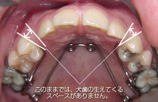 歯を抜かない歯科矯正（床矯正）に治療例